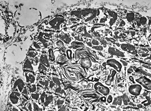 M,45y. | Fabry disease - myocardium M,45y. | Fabry disease - myocardium